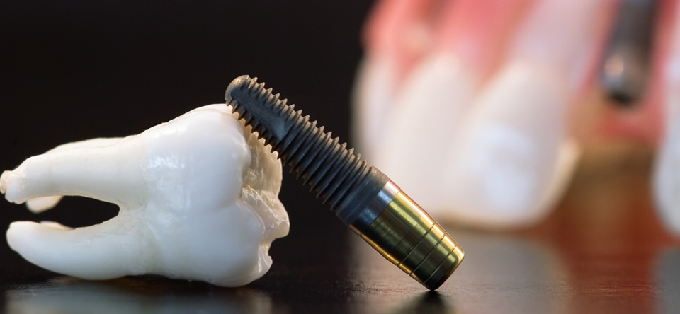 Zâmbet sănătos după tratament cu implant dentar